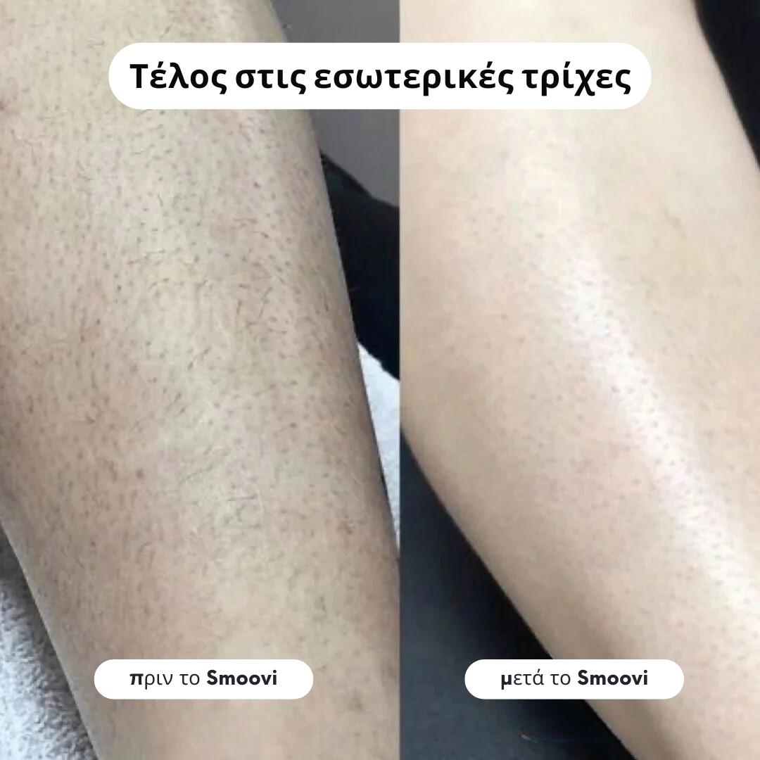 Ξυριστική Μηχανή Μπικίνι Smoovi 2.0