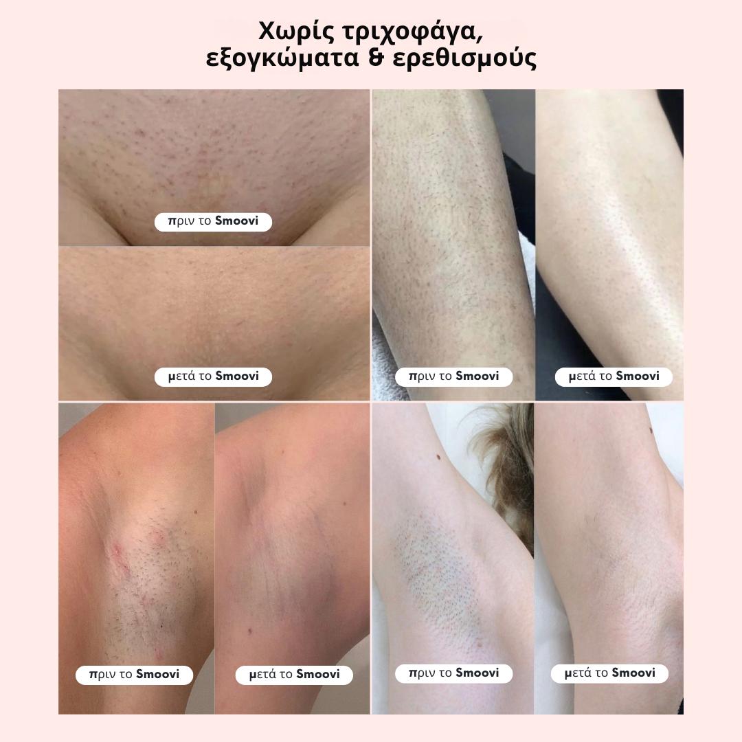 Ξυριστική Μηχανή Μπικίνι Smoovi 2.0