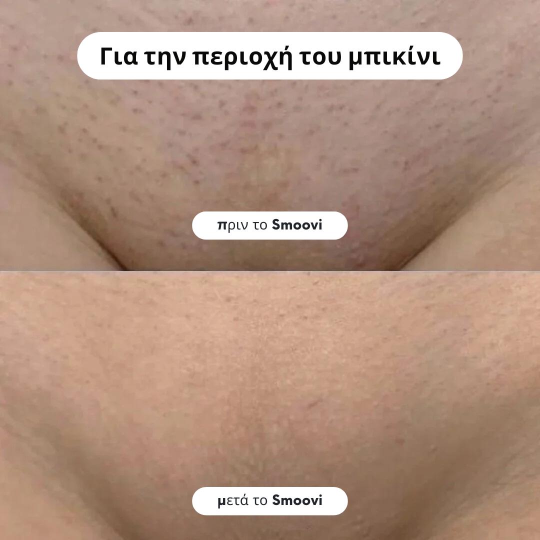 Ξυριστική Μηχανή Μπικίνι Smoovi 2.0